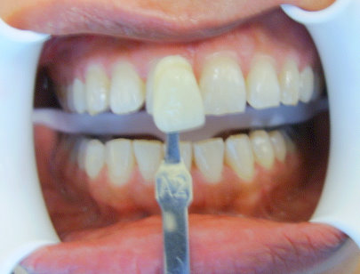 Image of a patient before whitening